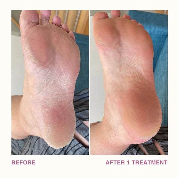 Dermelive Sole Saver Dual-Sided Foot File