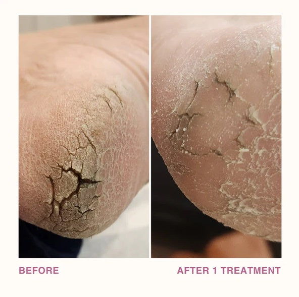Dermelive Pedi Pro Electronic Foot File