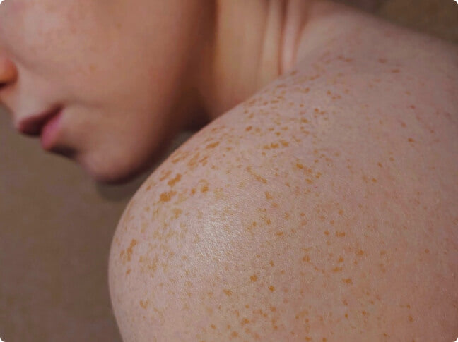 Dark spots on skin