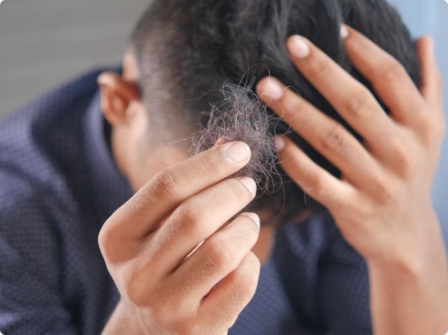 Minoxidil Manage Hair Loss