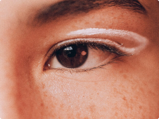 Pigmentation Conditions