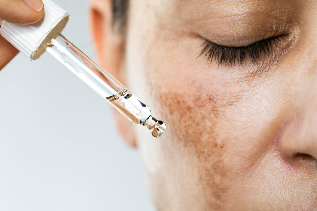 Exploring the Role of Compounding Pharmacies in Hyperpigmentation and Skin Pigmentation Treatments