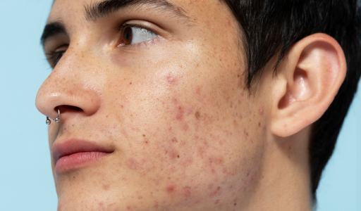 Top 3 Home Remedies for Acne