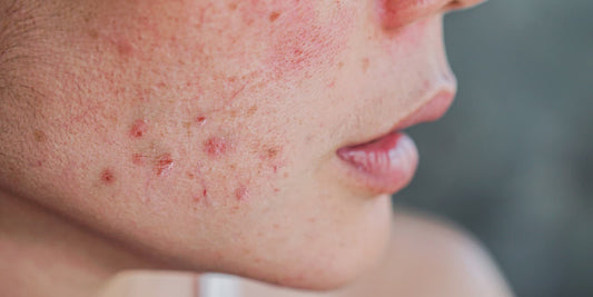 Why Professional Consultation for Your Acne Is Important