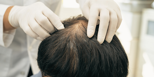 Compounded Hair Everything About Compounded Minoxidil for Hair Loss