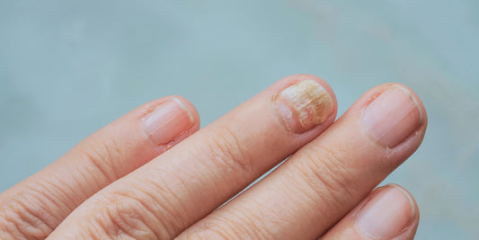 Understanding Fungal Infections & How to Fix Them