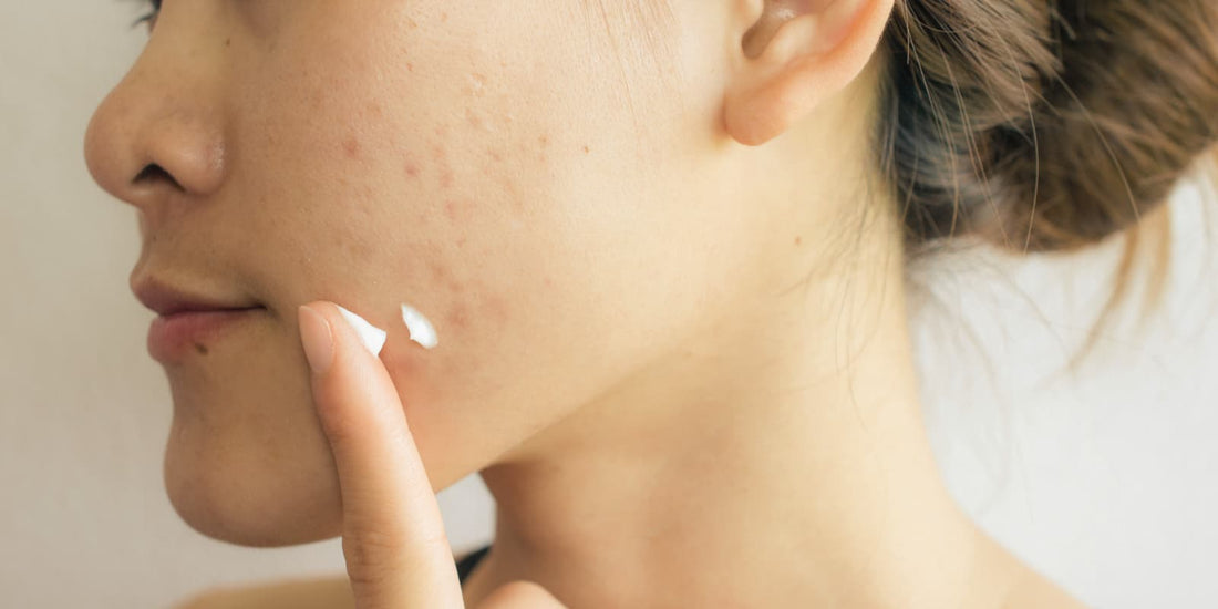 acne and pigmentation