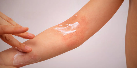 Essential Guide: Distinguishing Eczema From Other Common Skin Conditions in Children