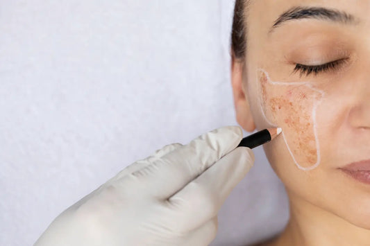How Personal Consultations Can Help Treat Hyperpigmentation Effectively