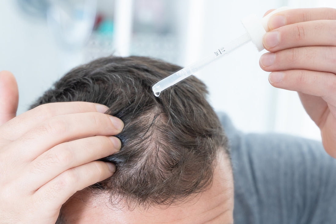 Compounding Hair Loss Minoxidil in Australia: Why Personalised Hair Regrowth Treatments Are on the Rise