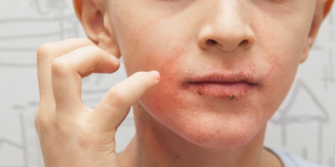 How Do Over-the-Counter Eczema Creams for Children Compare to Prescription Medications